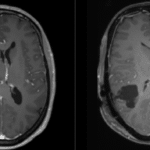 Az egyik leghalálosabb rák ellen is hatásos lehet egy újfajta orrcsepp