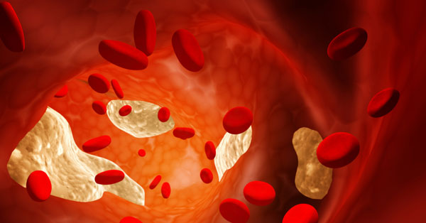 4 hatékony gyógynövény érelmeszesedés ellen