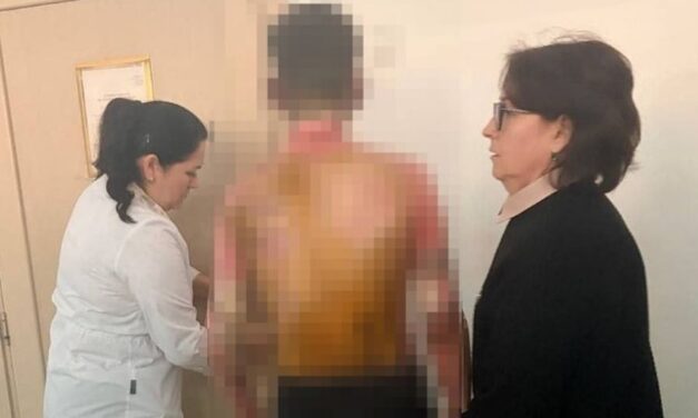 Nyakon öntötte benzinnel, majd felgyújtotta osztálytársát egy nyolcadikos orosz kislány