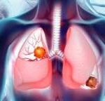 Meglepő összefüggést találtak a COVID és a tüdőrák között