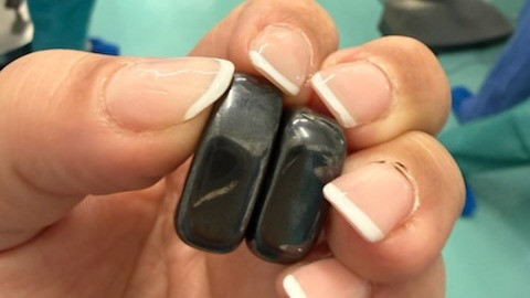 20 mágnest nyelt le egy gyerek, sebészt kellett hívni