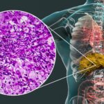 Meglepő helyről érkezhet a zsírmáj ellenszere